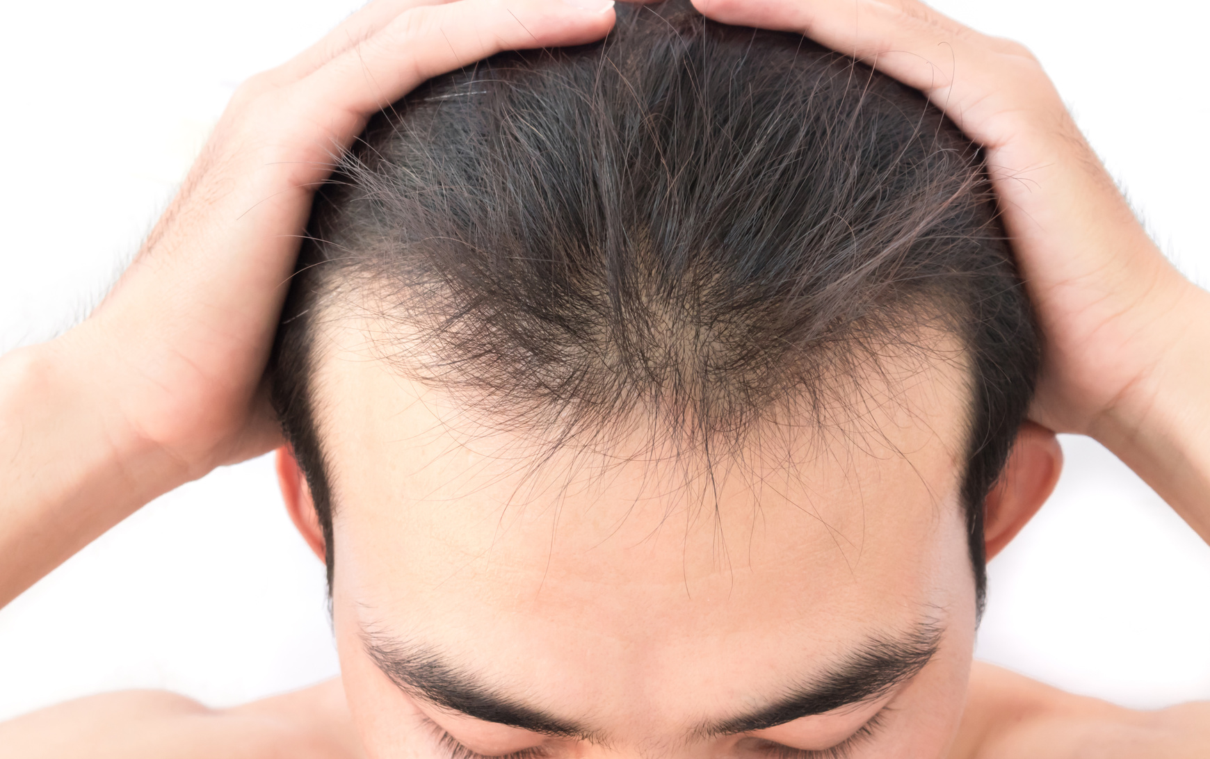 Mittel gegen Haarausfall: Was Frau und Mann tun können NTH.